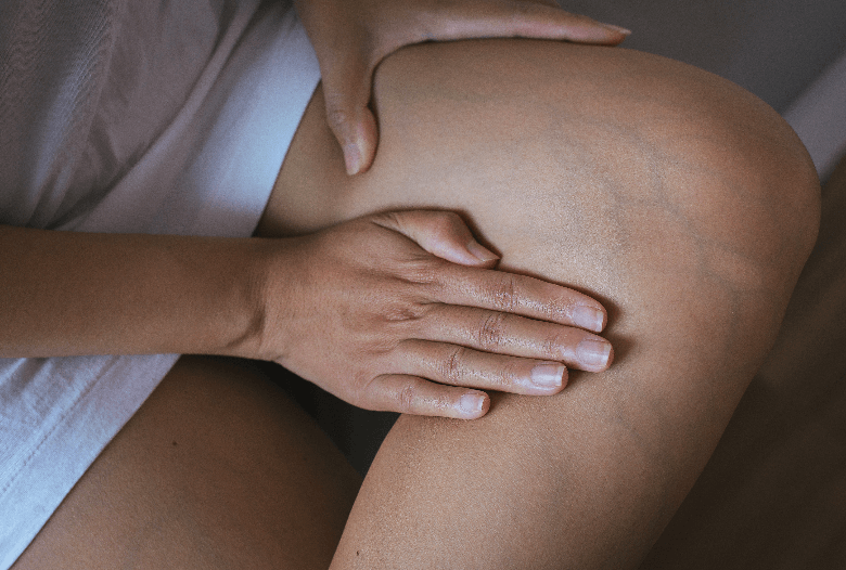 VARICOSE VEINS TREATMENT